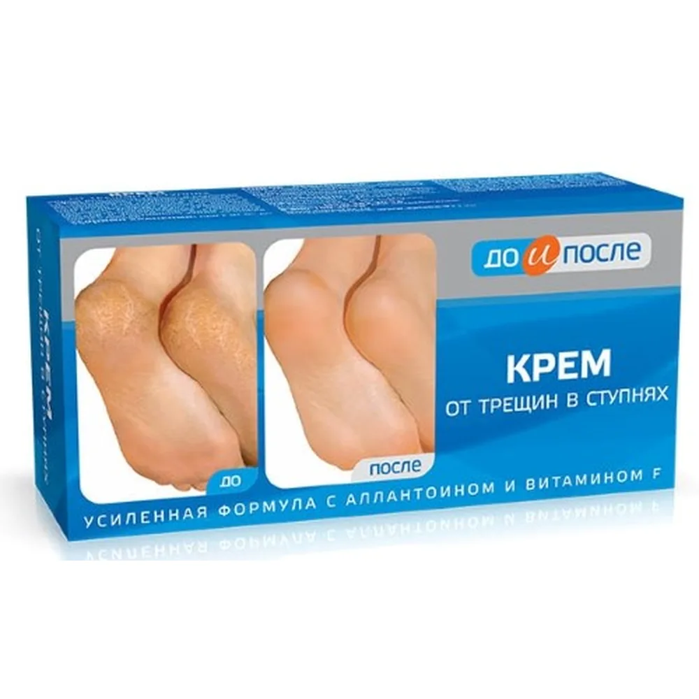 Before and After Cream for Cracked Heels 150 ml